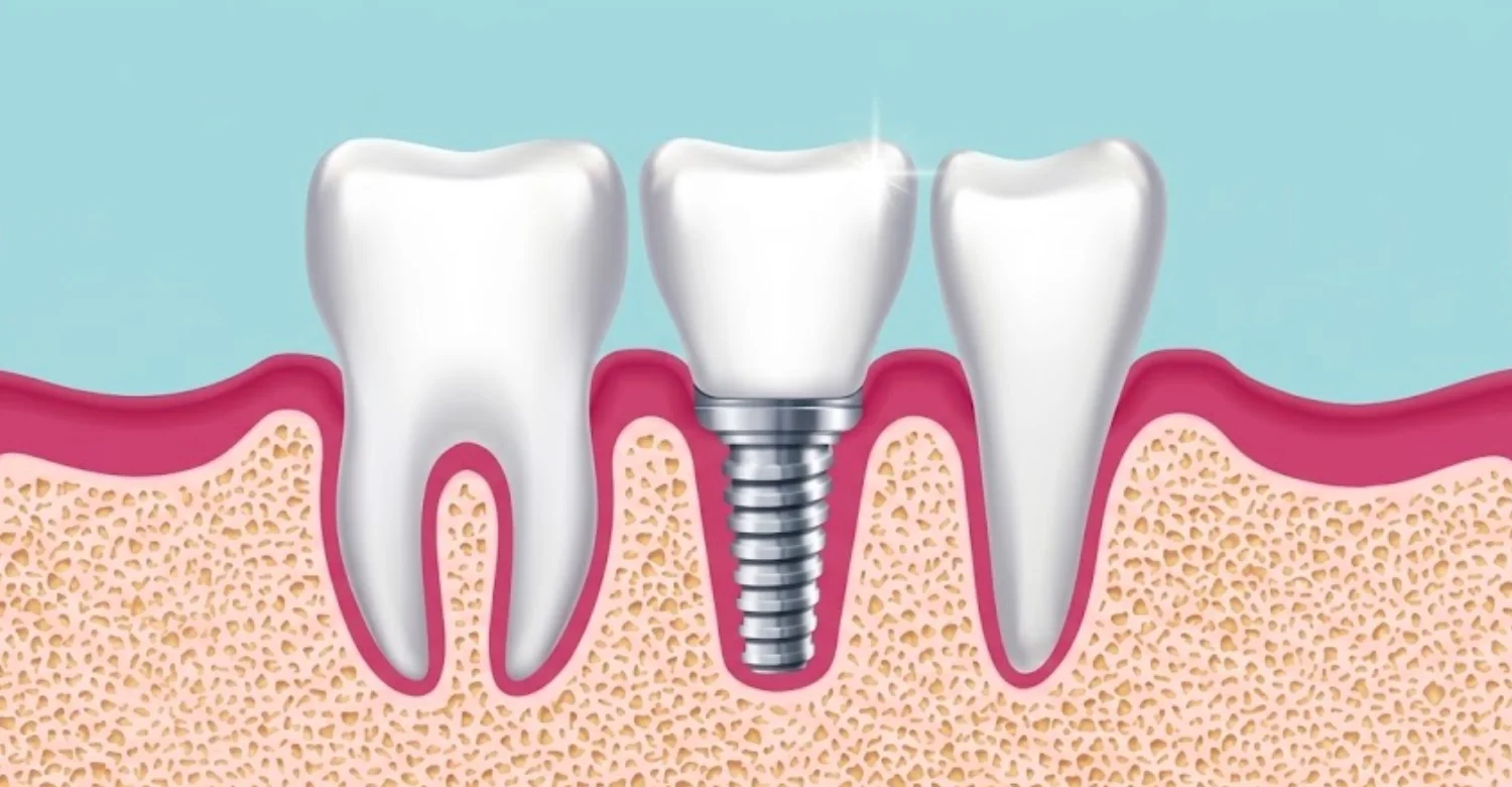 benefits of dental implants1
